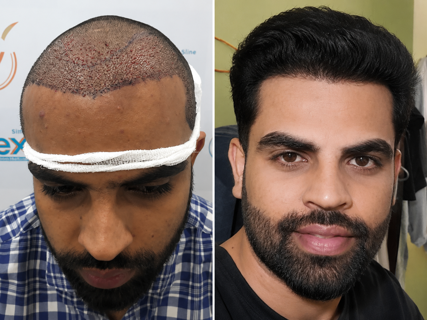 Hair Transplant Result
